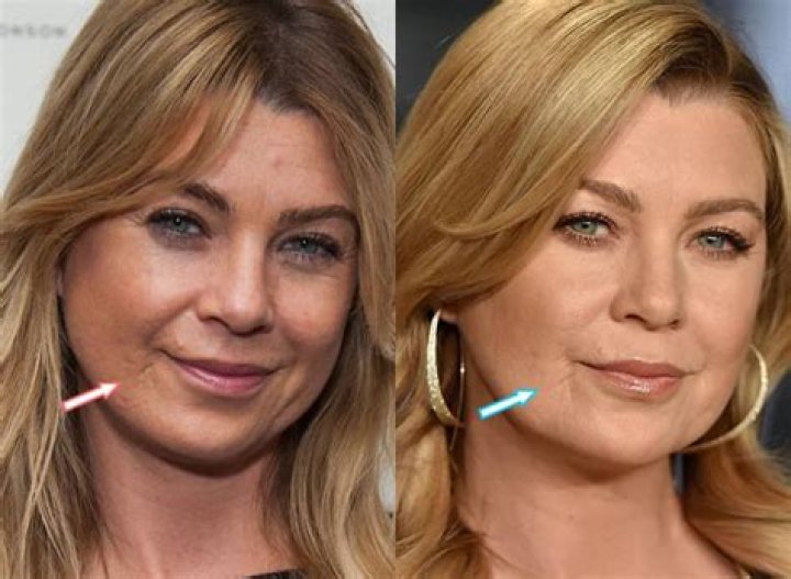 Ellen Pompeo's Lip Filler Journey: A Closer Look