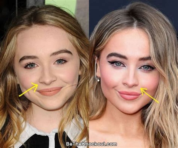 Understanding Sabrina Carpenter's Surgery Journey