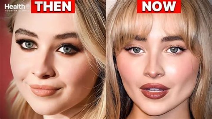 Sabrina Carpenter's Lip Filler: Exploring The Transformation